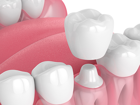 The image shows a close-up of multiple artificial teeth set against a pink background, likely for dental implant or prosthetic purposes.