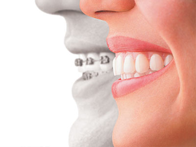 The image shows a close-up of a person s smiling face with a superimposed, distorted representation of their teeth and mouth, suggesting an advertisement for dental care or orthodontic services.