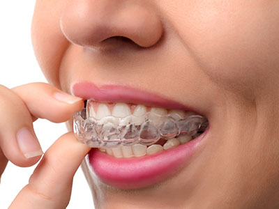 The image shows a person holding a clear dental retainer with their fingers.