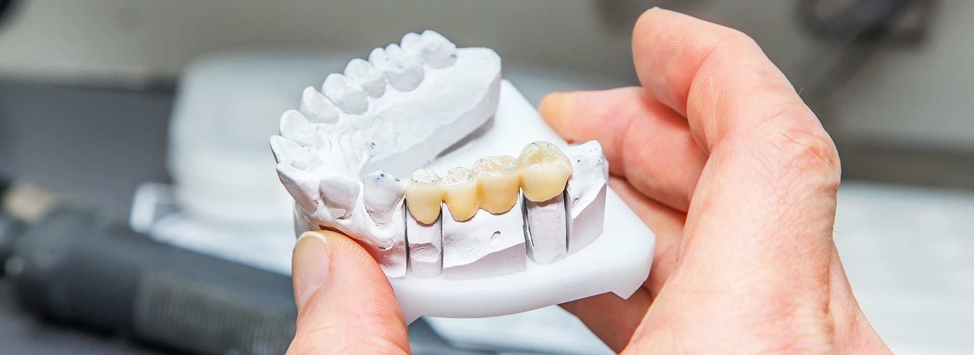 The image shows a person holding a dental implant model with visible teeth structures.