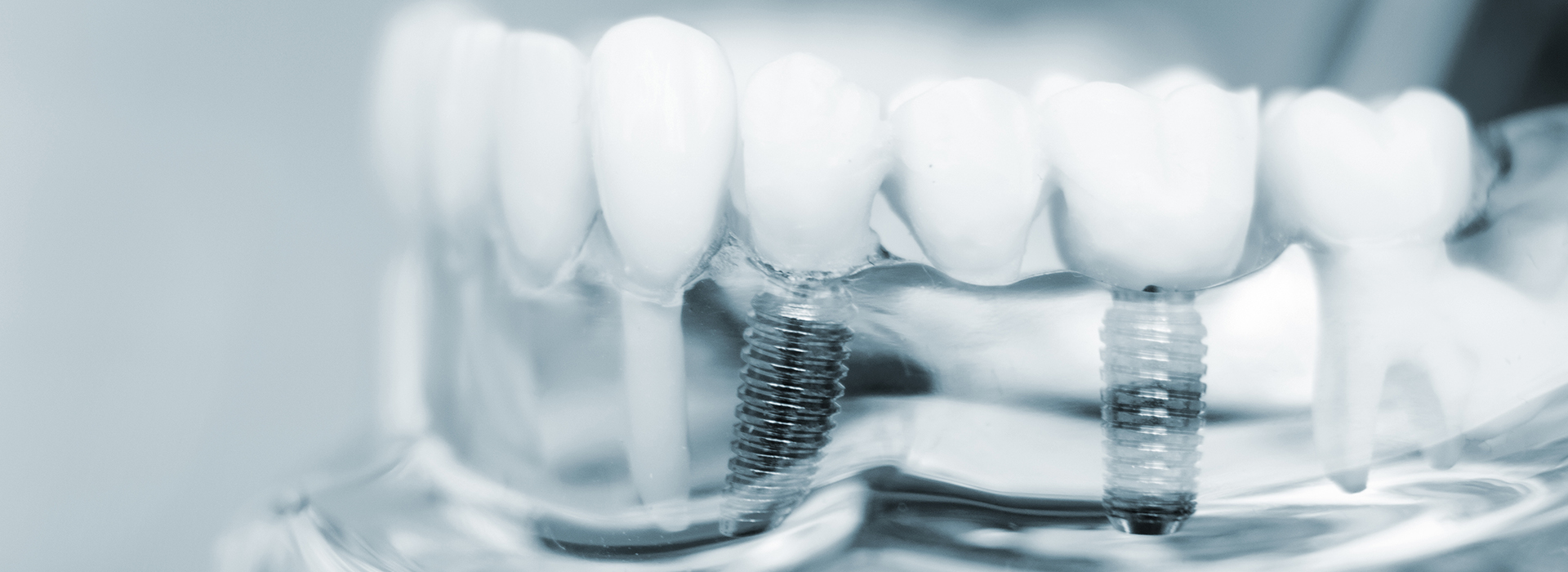 A close-up photograph of a dental implant with screws and abutments, showcasing its structure for educational or informational purposes.