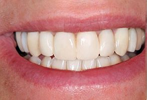 The image shows a person s mouth with a bright smile, displaying straight white teeth and a clean oral cavity.