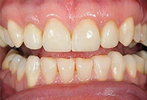 The image shows a close-up view of a person s teeth with yellowish stains, indicating potential dental issues such as discoloration or decay.