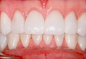 The image shows a close-up of a person s teeth with visible stains, likely for dental care purposes.