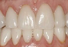 The image shows a close-up view of a person s teeth with a focus on the front teeth, which appear to be discolored or stained.