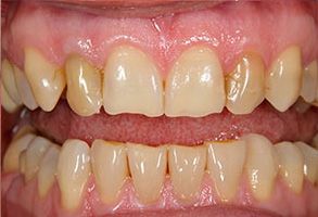 The image shows a close-up view of a person s teeth with yellowing, indicating dental issues such as staining or decay.