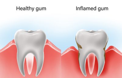 Diagram showing gum disease on a tooth. Inflammed gums from gum disease vs healthy tooth