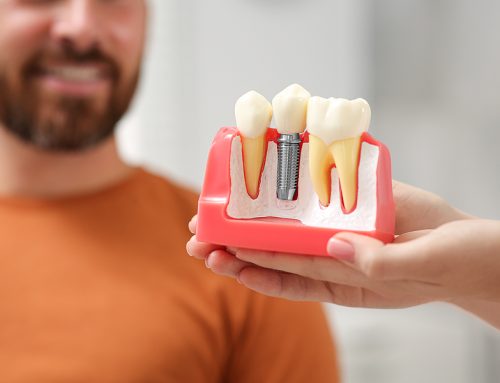 Dental Implants FAQ